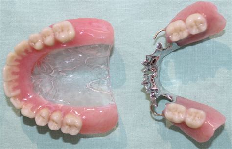 pictures of metal partial dentures